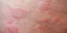 Le allergie nel bambino: tutto i genitori hanno bisogno di conoscere la diagnosi e il trattamento