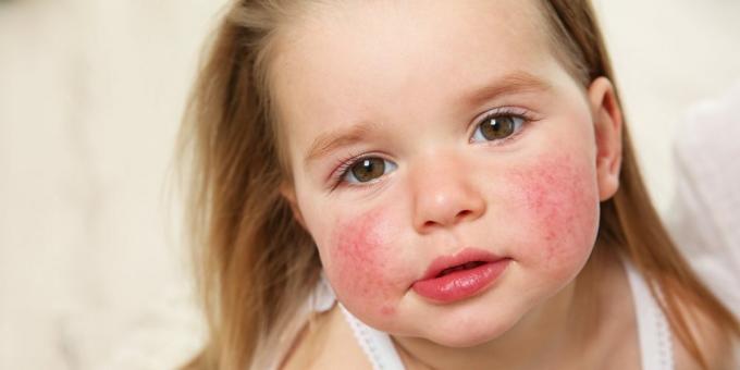 Eruzione cutanea facciale: allergia alimentare