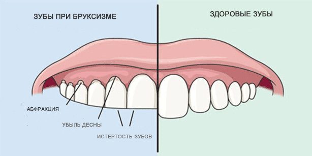 Digrignamento dei denti: i denti e denti sani durante il bruxismo
