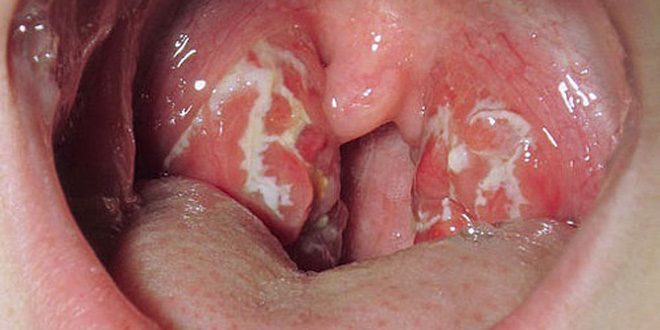 I sintomi della tonsillite