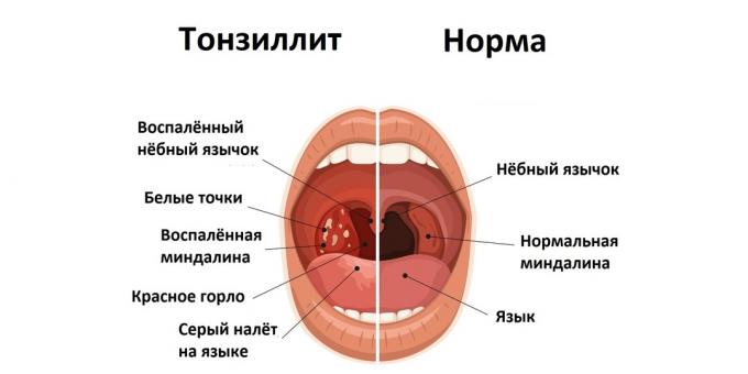 Tonsillite e condizioni normali 