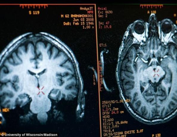 immagine del cervello Matthieu Ricard ottenuto con la risonanza magnetica