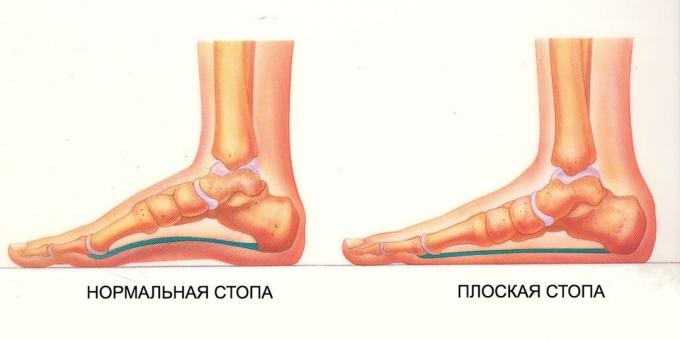esercizi per i piedi piatti: piede normale e piatta
