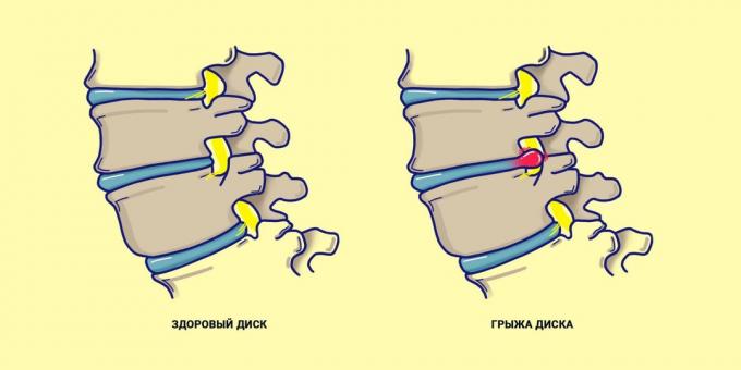 Ernia colonna vertebrale rispetto ad una schiena sana