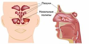Cosa sono i polipi nel naso e come vengono trattati?