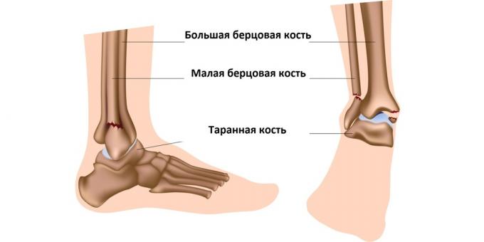 La frattura della caviglia colpisce le ossa che compongono l'articolazione della caviglia