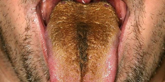placca nera sulla lingua