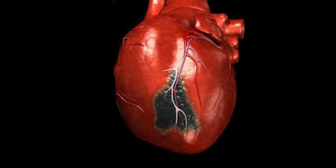 I sintomi di un attacco di cuore, per la quale è necessario chiamare un'ambulanza