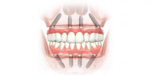 Come ripristinare i denti e il sorriso