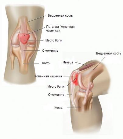sindrome del dolore femoro-rotulea