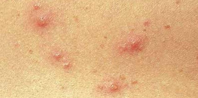 I sintomi della varicella nei bambini e negli adulti: Molto spesso, la pelle appare subito piccoli puntini rossi