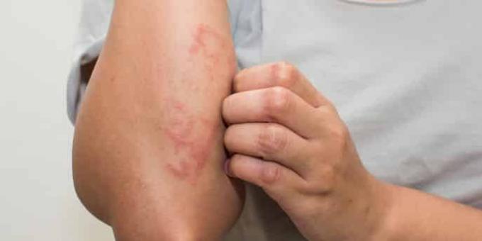 Verificare i sintomi con i sintomi di allergia
