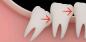 Al termine della rimozione dei denti del giudizio fa bene alla salute
